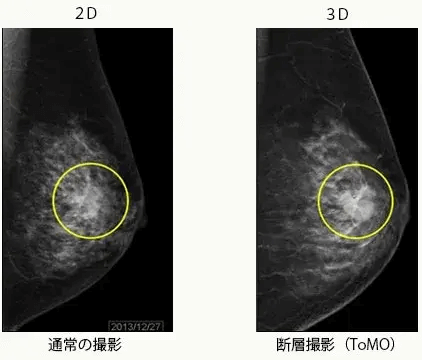 通常(2D)とデジタルトモシンセシス(3D)2