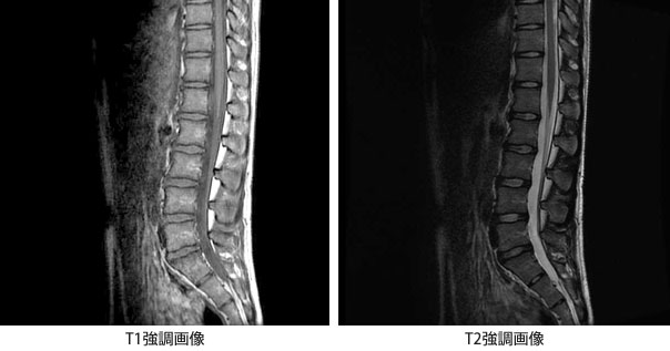 脊椎MRI画像