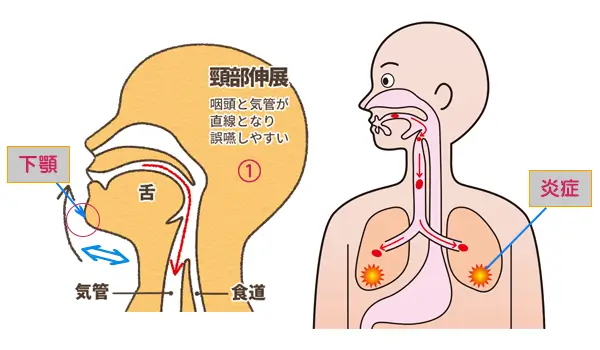 頚部伸展‥･首が後方へいき、顎が上を向いた状態