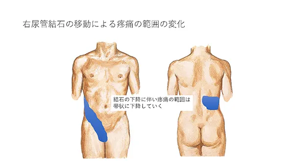 右尿管結石の移動による疼痛の範囲の変化