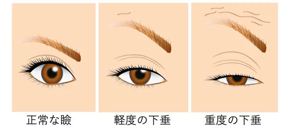 正常な瞼と眼瞼下垂した瞼
