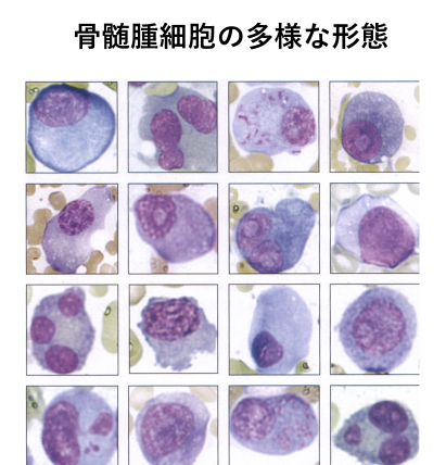 多発 性 骨髄 腫 に なっ ちゃい まし た