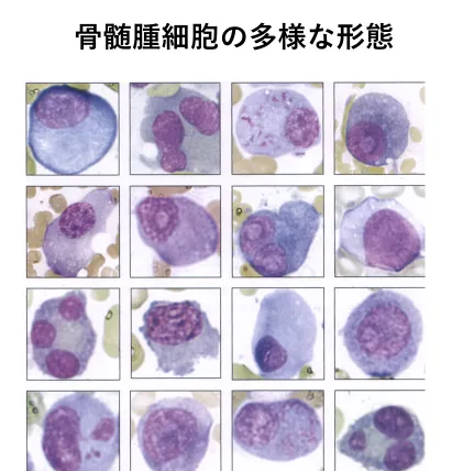 多種多様な骨髄腫の細胞形態