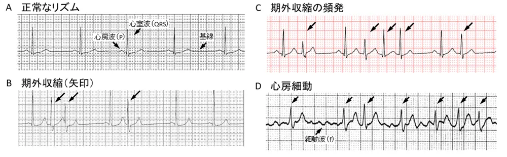 多種多様な遺伝子変異をもつ骨髄心房細動とは腫細胞