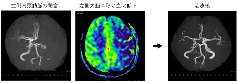 心房細動による脳梗塞