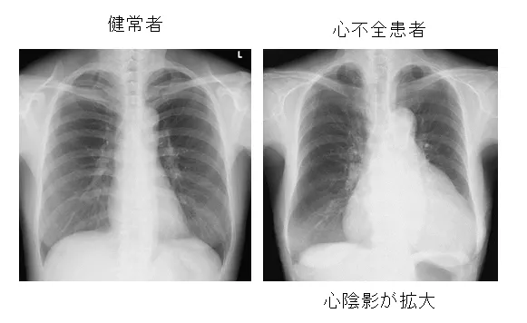 心不全のレントゲン