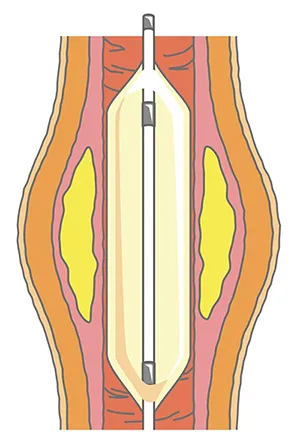 図3. バルーン治療