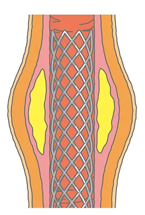 図4. ステント治療