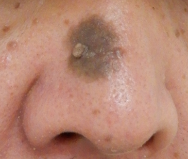 鼻の脂漏性角化症