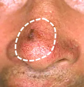 鼻の基底細胞上皮癌