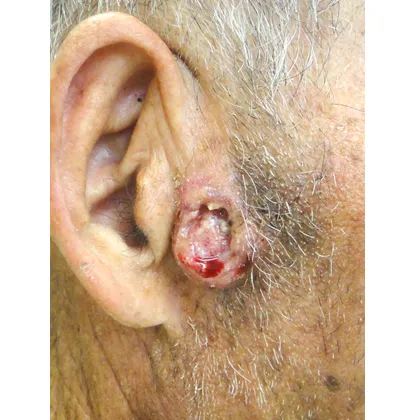 右耳前部の有棘細胞癌