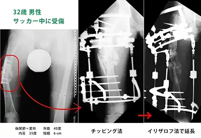 イリザロフ法