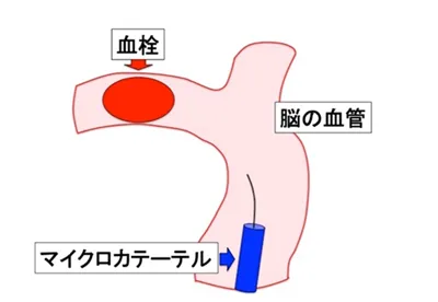 脳のカテーテル治療イメージイラスト