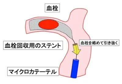 脳のカテーテル治療イメージイラスト