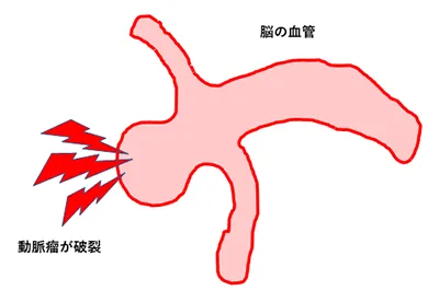 脳動脈瘤に対するカテーテル治療イメージイラスト