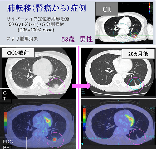 肺転移のサイバーナイフ治療例