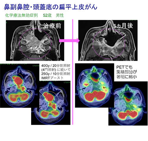 頭頸部がんの放射線治療例