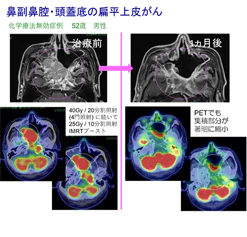 頭頸部がんの放射線治療例