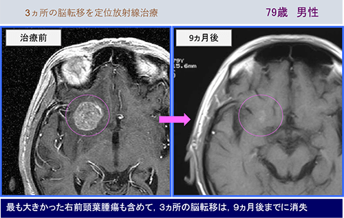 アブスコパル効果がうかがわれた症例