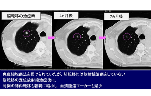 アブスコパル効果がうかがわれた症例（小さい肺転移も著明に縮小）