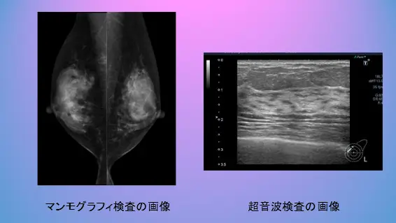 図１　マンモグラフィ検査と超音波検査の画像