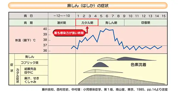 麻しん（はしか）の経過