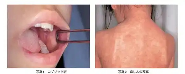 麻しん（はしか）の発疹