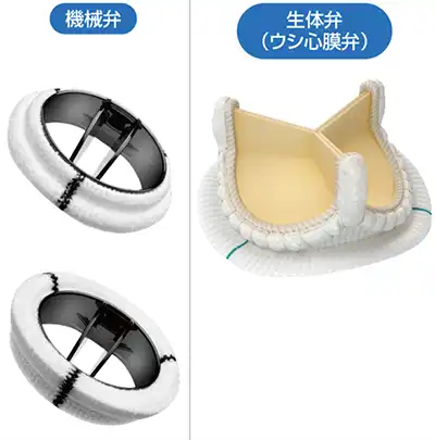 生体弁・機械弁の画像