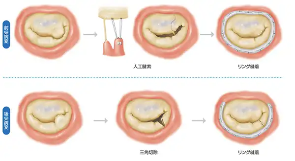 僧帽弁形成術について