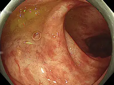 潰瘍性大腸炎治療後