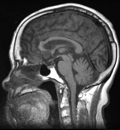 パーキンソン病の頭部MRIは異常ありません
