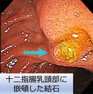 十二指腸の乳頭部に嵌頓した結石