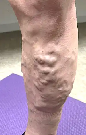 大伏在静脈型