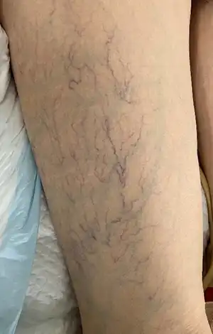 蜘蛛の巣状静脈瘤