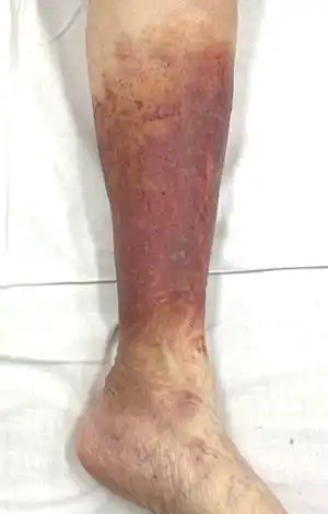 うっ滞性皮膚炎