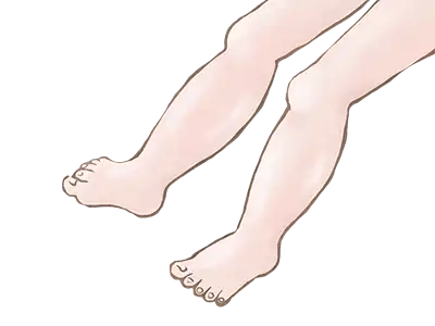 下肢静脈瘤について～誤解の多い身近な病気～