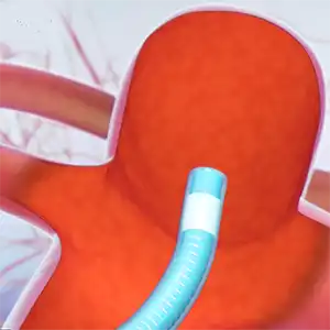 瘤内フローディスラプター治療のイメージ