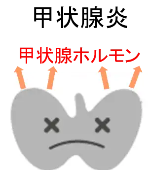 甲状腺炎のイメージ