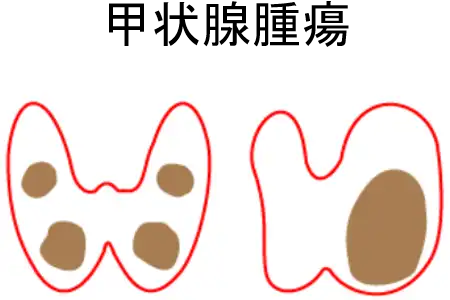 甲状腺腫瘍のイメージ