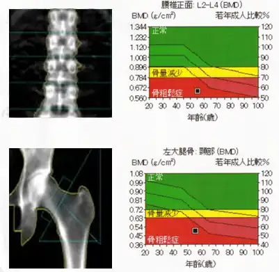 骨粗鬆症のイメージ