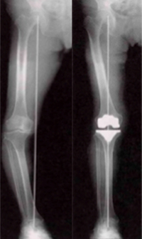 人工膝関節置換術