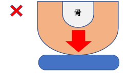 図②　硬い素材では骨突出部に圧が集中する