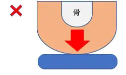 図② 硬い素材では骨突出部に圧が集中する