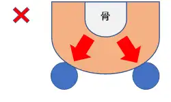図④ 円座は骨突出部を浮かせてその周りを圧迫している