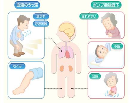 心不全の症状