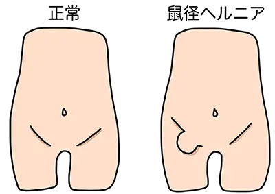 本当は怖い鼠径（そけい）ヘルニア