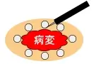 ESDの治療方法1