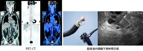 PET-CT画像と超音波内視鏡下穿刺吸引術画像