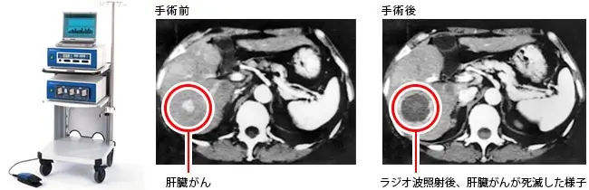 ラジオ波治療のCT映像の様子