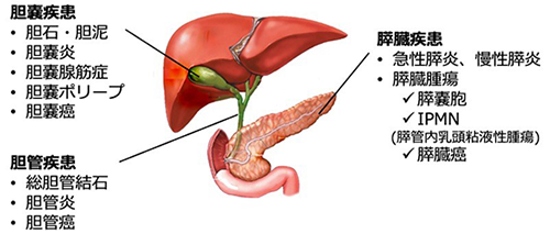 胆道（胆嚢・胆管）の病気